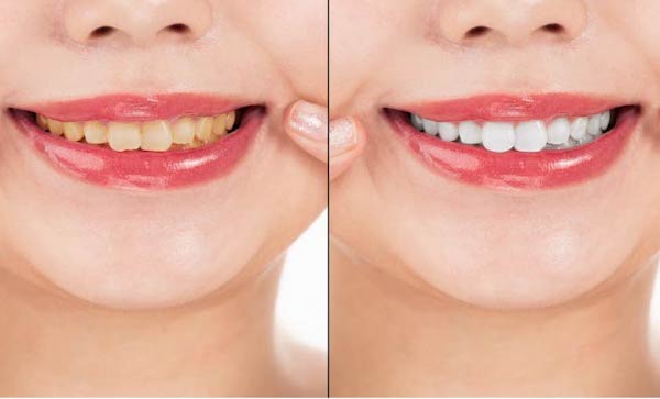 【ホワイトニング】シャインPGの口コミ・評判は?他のホワイトニング歯磨き粉との違いと選び方