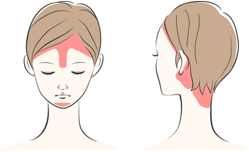 【脂漏性皮膚炎対策】カダソン（KADASON）の口コミ・評判から分かる選ばれる3つの理由