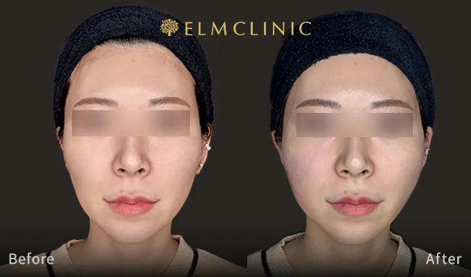 【口コミ・評判】糸リフトならエルムクリニック！エルムリフトの特徴と選ばれる3つの理由